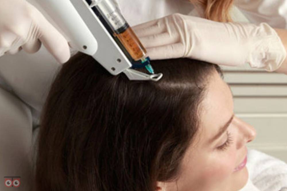 تخفیف ویژه مزوتراپی موی سر تخفیف ویژه مزوتراپی موی سر