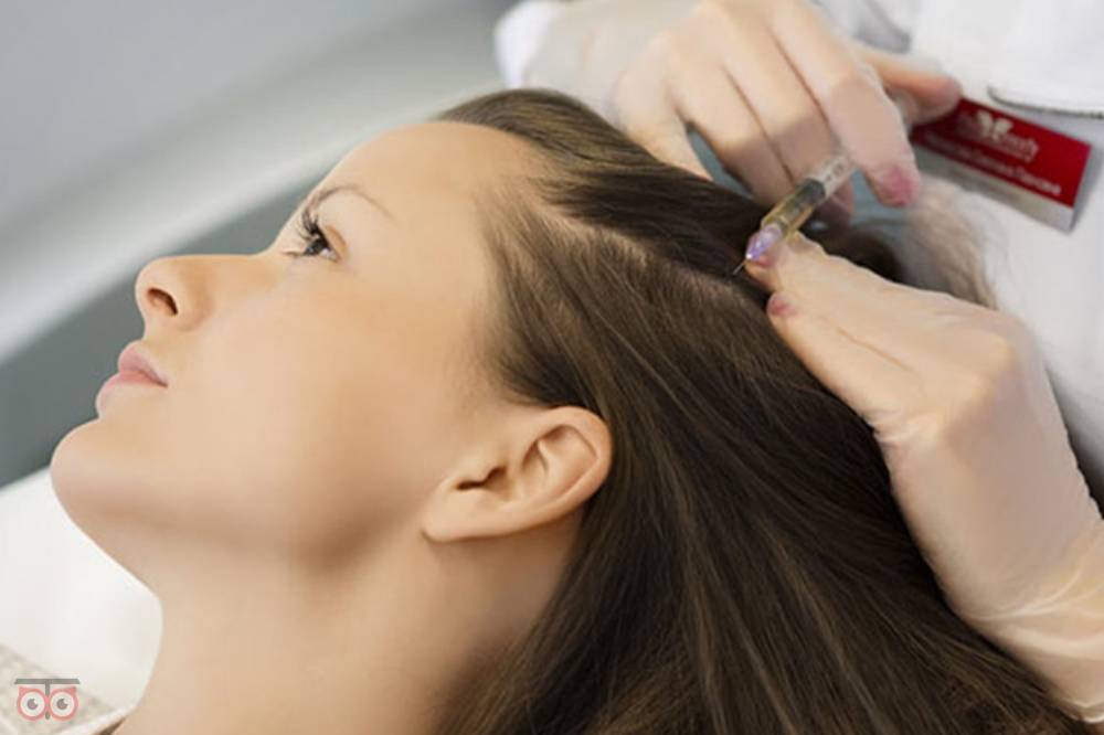 تخفیف ویژه مزوتراپی موی سر تخفیف ویژه مزوتراپی موی سر