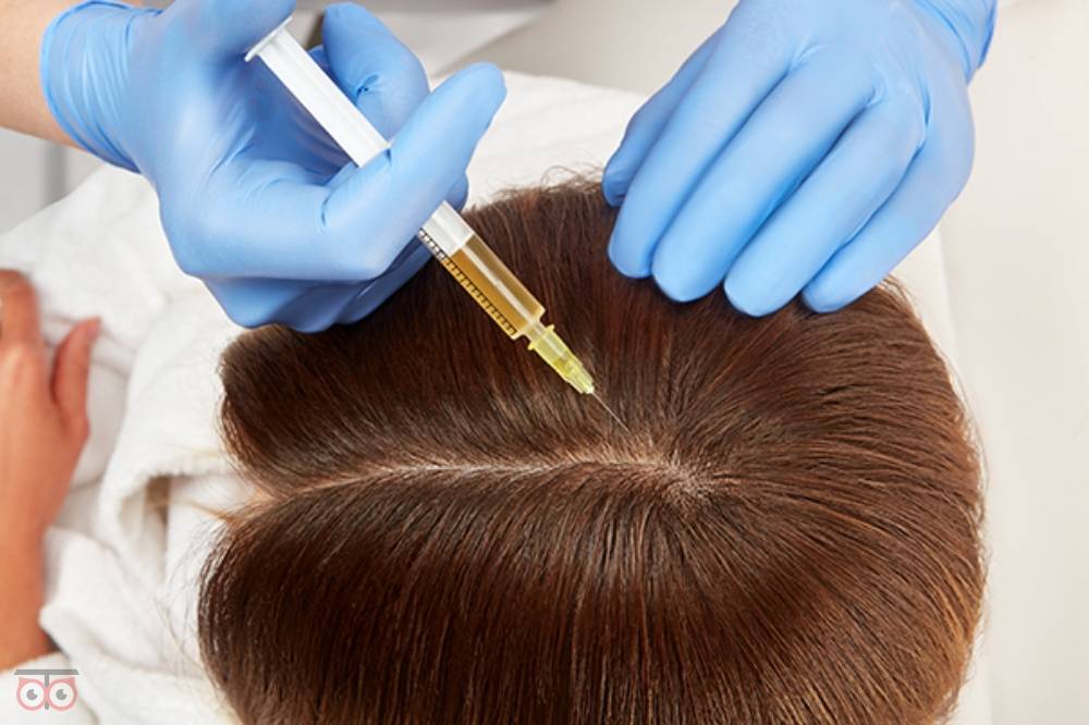 تخفیف ویژه مزوتراپی موی سر تخفیف ویژه مزوتراپی موی سر