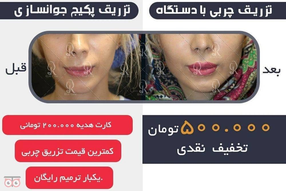 تخفیف ویژه تزریق چربی تخفیف ویژه تزریق چربی