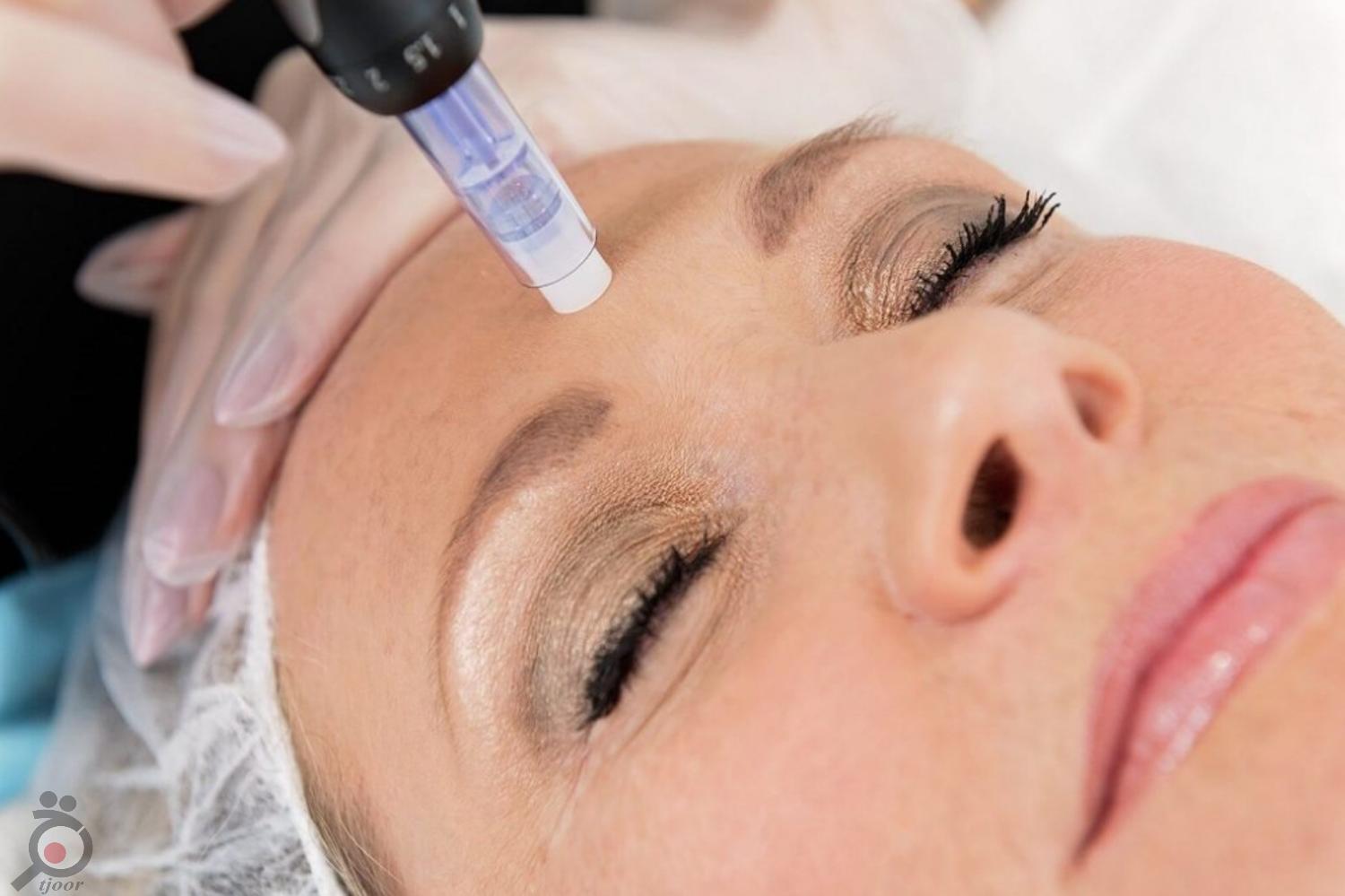 تخفیف ویژه مزوتراپی تخفیف ویژه مزوتراپی