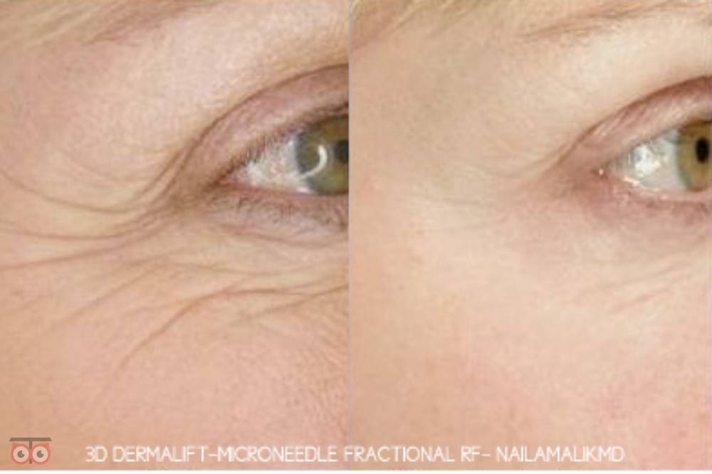 تخفیف ویژه RF فرکشنال تخفیف ویژه RF فرکشنال