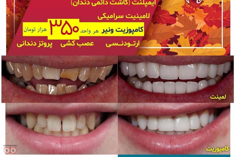 تخفیف ویژه ایمپلنت دندان تخفیف ویژه ایمپلنت دندان