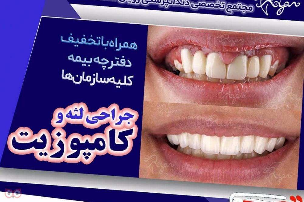 تخفیف ویژه ایمپلنت دندان تخفیف ویژه ایمپلنت دندان