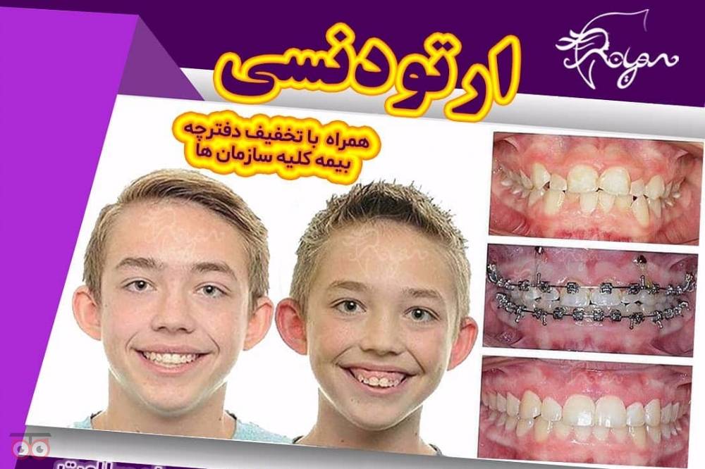 تخفیف ویژه ارتودنسی تخفیف ویژه ارتودنسی