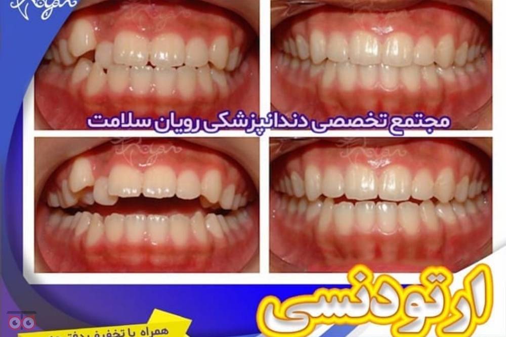 تخفیف ویژه ارتودنسی تخفیف ویژه ارتودنسی