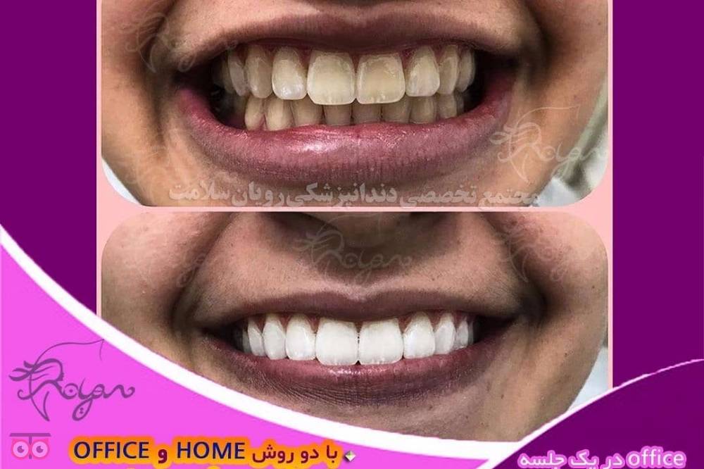 تخفیف ویژه ارتودنسی تخفیف ویژه ارتودنسی