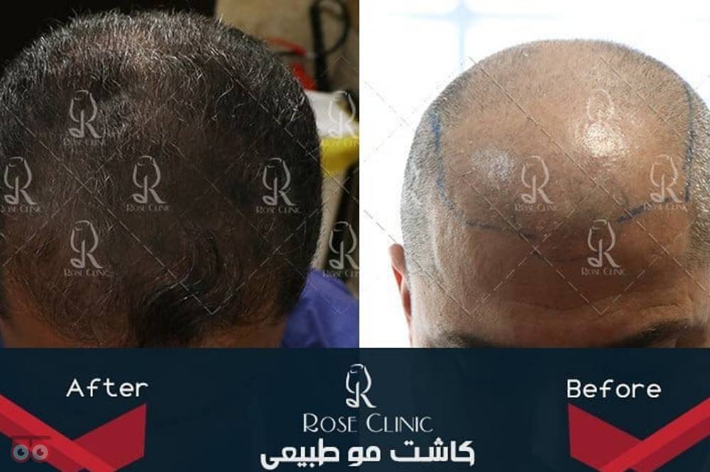 تخفیف ویژه کاشت مو تخفیف ویژه کاشت مو