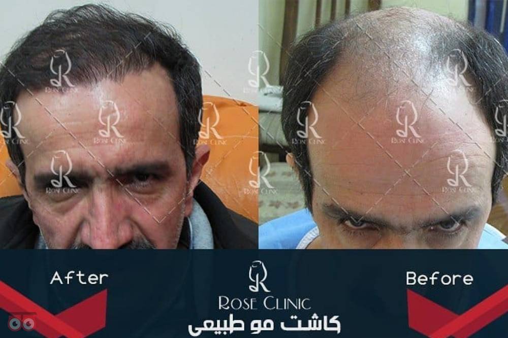 تخفیف ویژه کاشت مو تخفیف ویژه کاشت مو