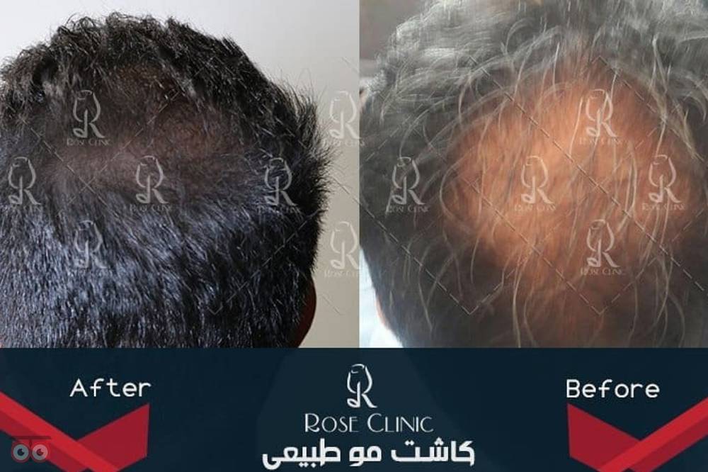 تخفیف ویژه کاشت مو تخفیف ویژه کاشت مو
