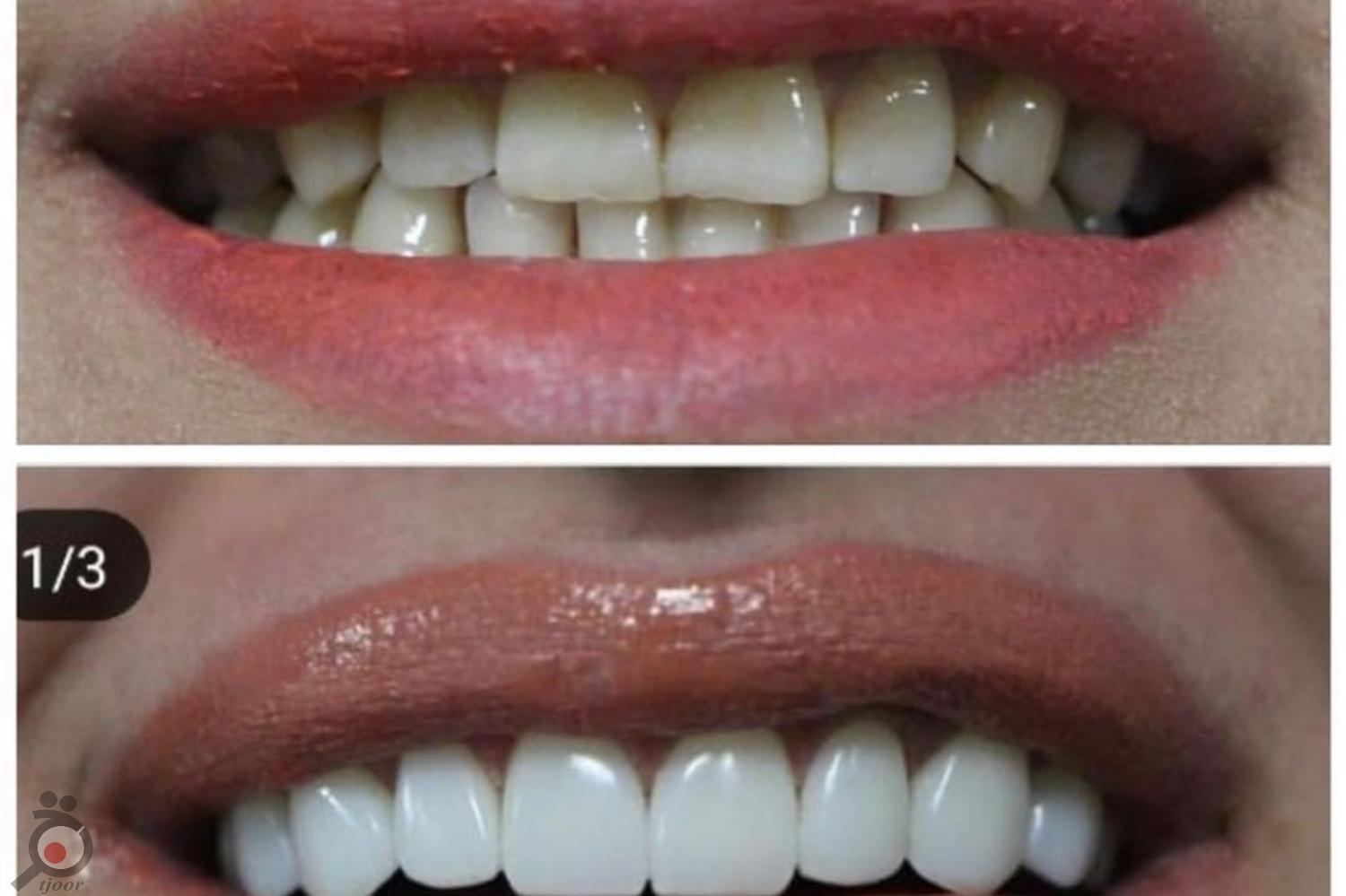 تخفیف ویژه کامپوزیت تخفیف ویژه کامپوزیت