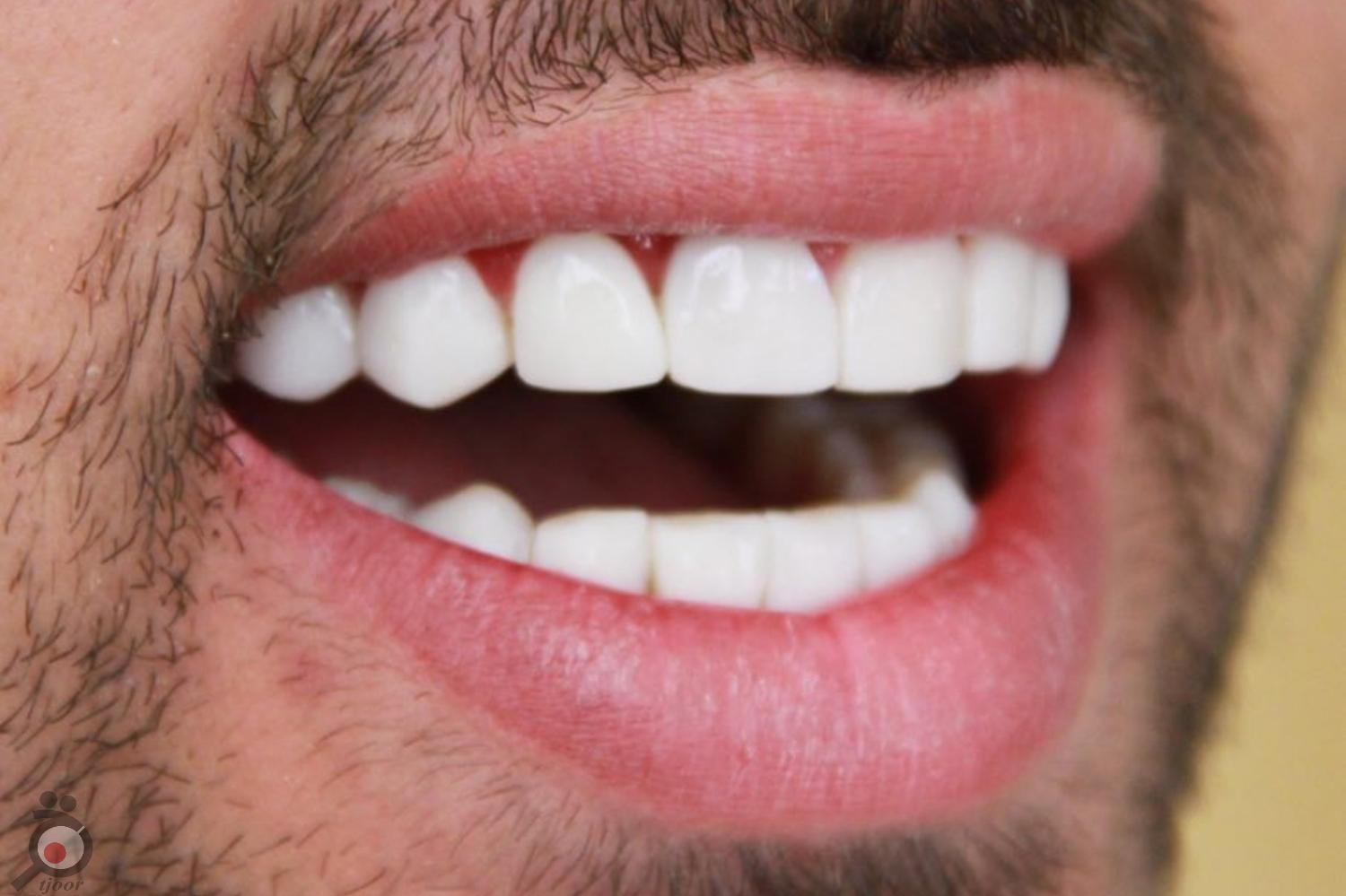 تخفیف ویژه کامپوزیت تخفیف ویژه کامپوزیت