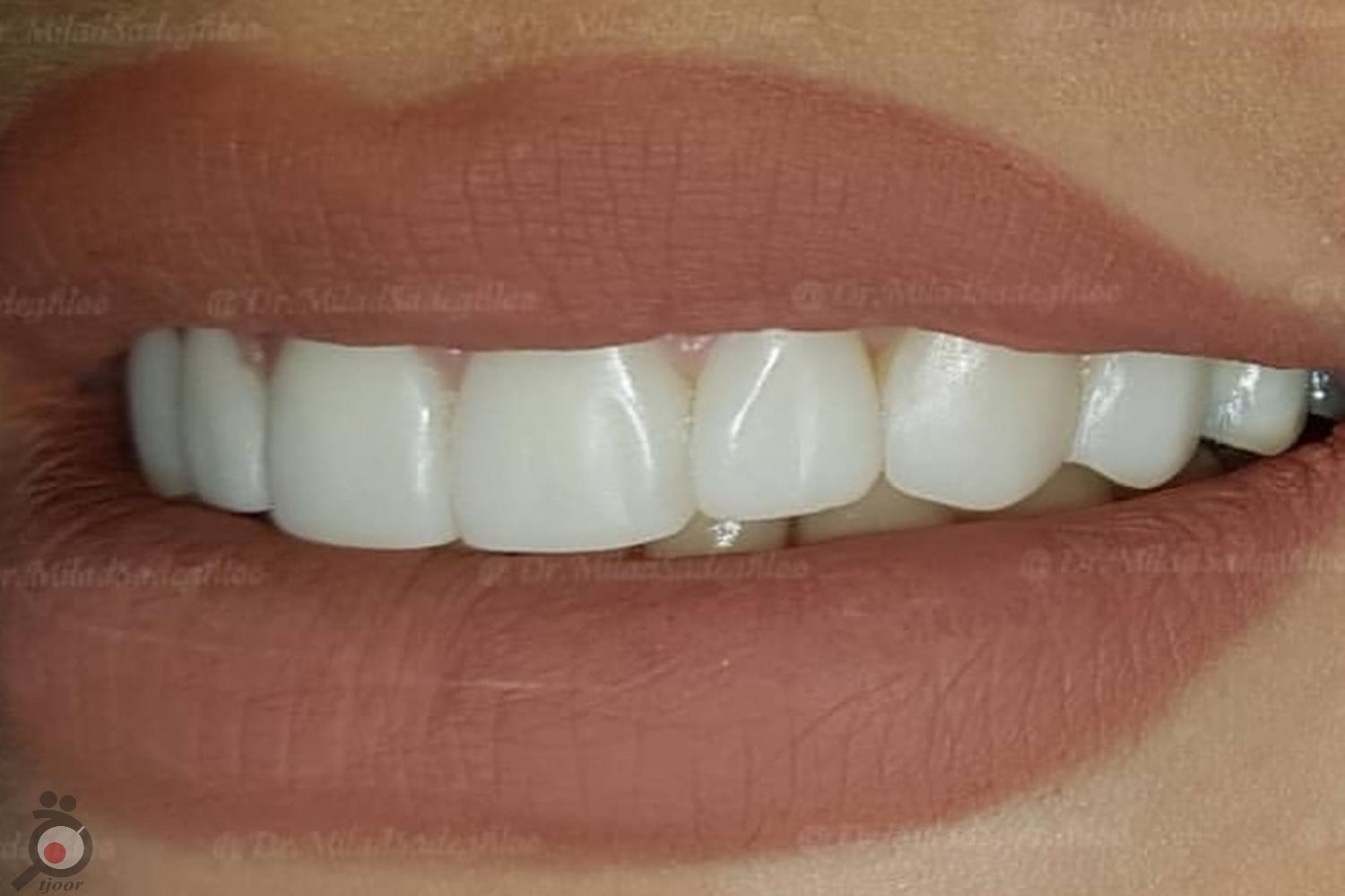 تخفیف ویژه کامپوزیت تخفیف ویژه کامپوزیت