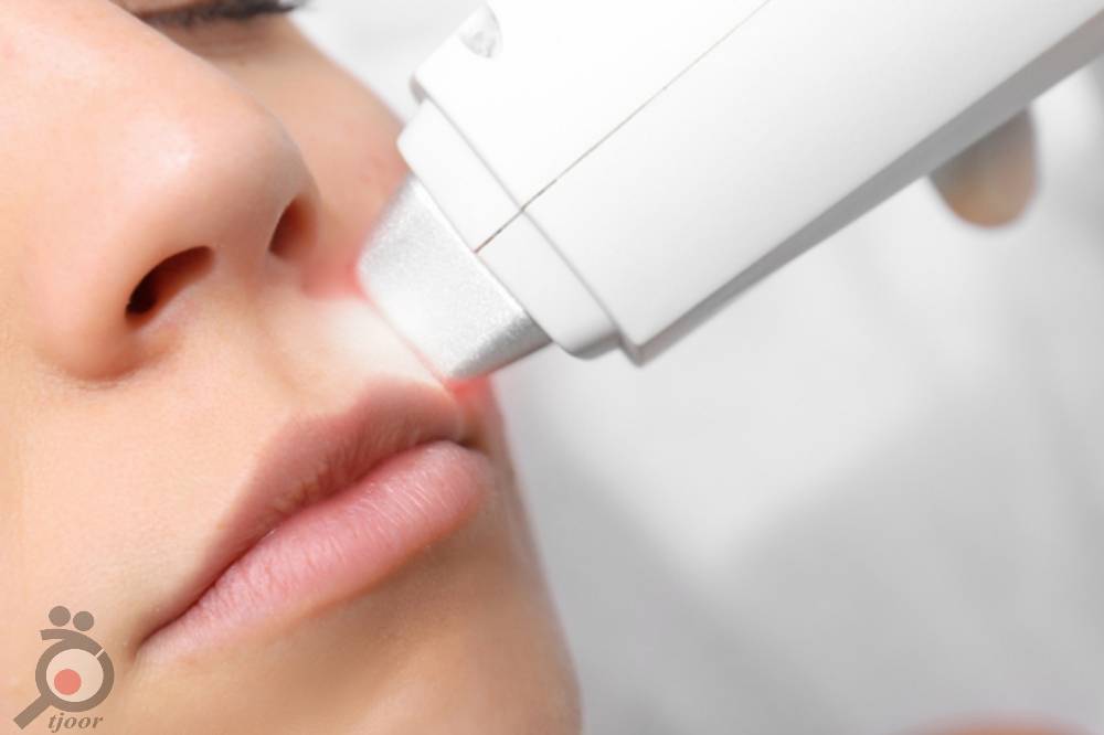 تخفیف ویژه لیزر تخفیف ویژه لیزر