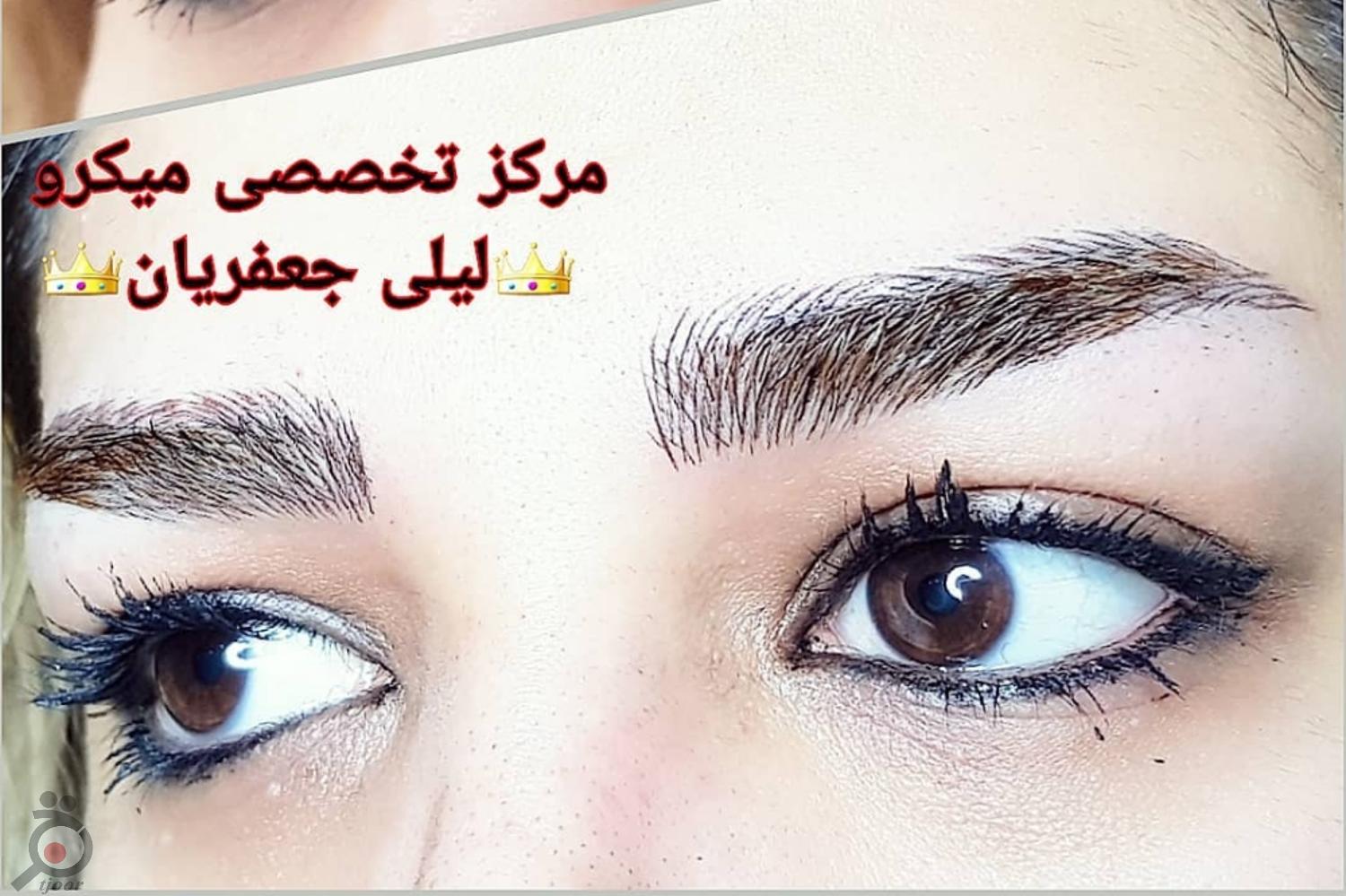 تخفیف میکروپیگمنتیشن تخفیف میکروپیگمنتیشن