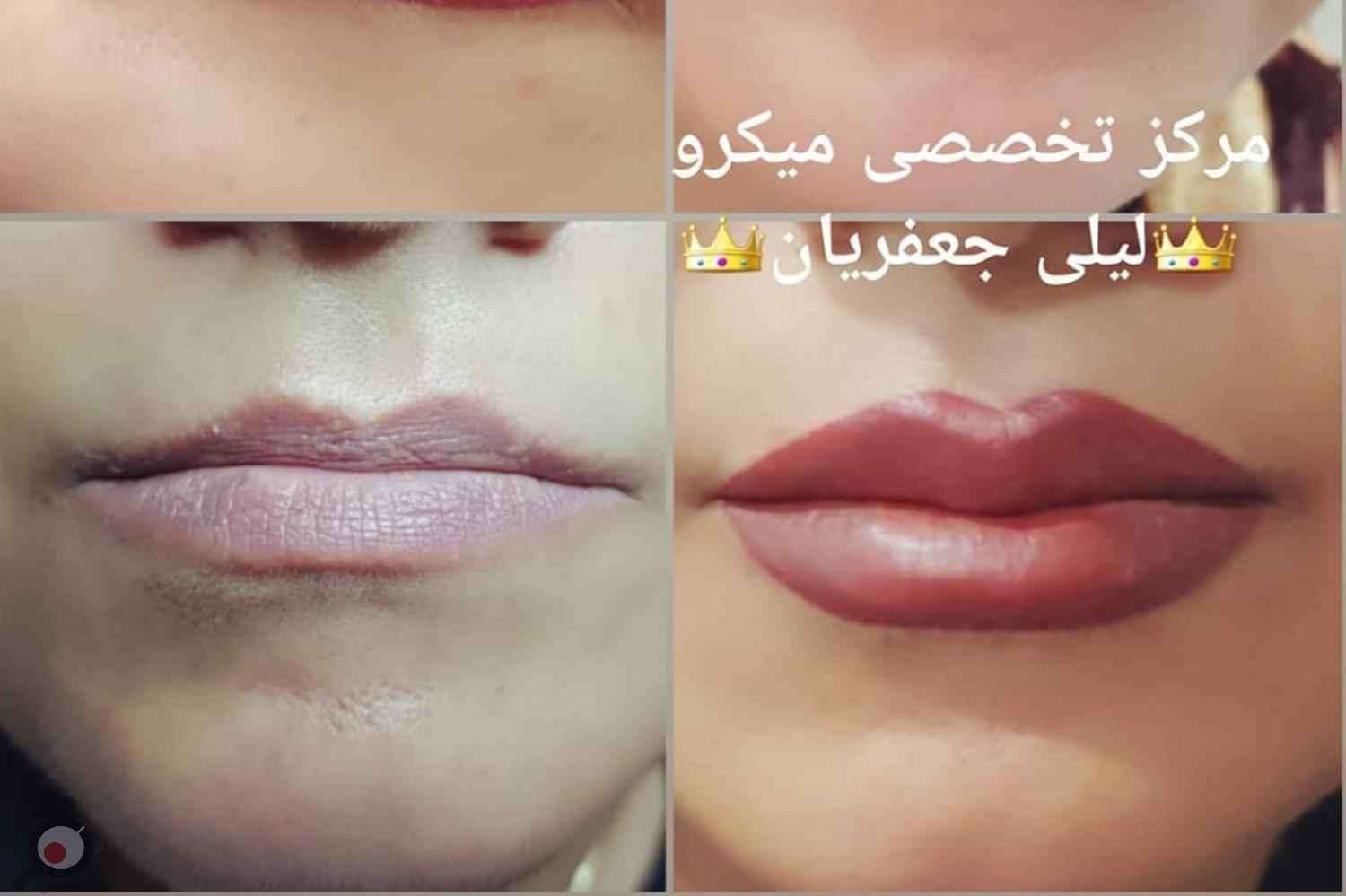 تخفیف میکروپیگمنتیشن تخفیف میکروپیگمنتیشن