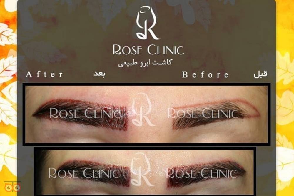 تخفیف کاشت ابرو تخفیف کاشت ابرو