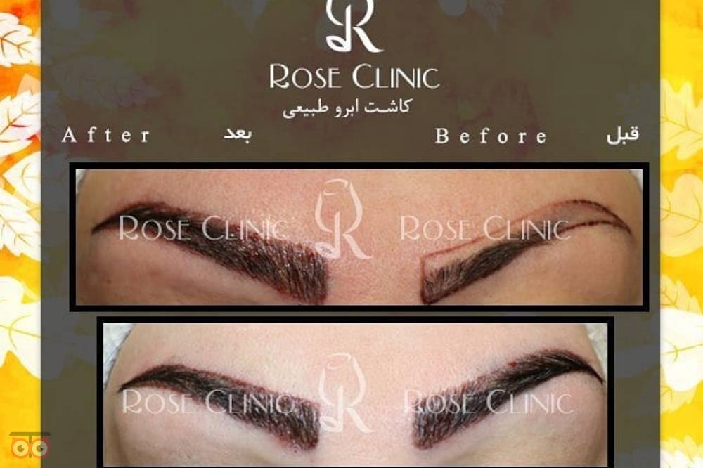 تخفیف کاشت ابرو تخفیف کاشت ابرو