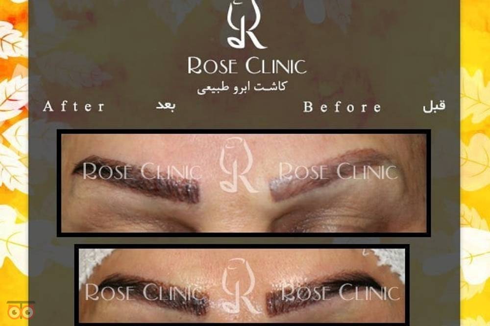 تخفیف کاشت ابرو تخفیف کاشت ابرو