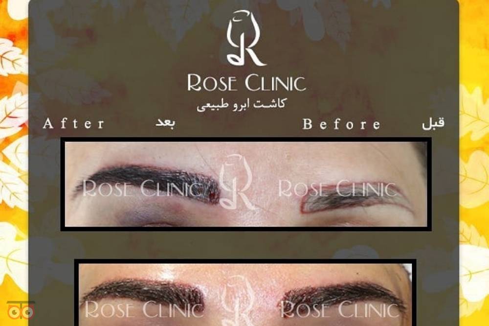 تخفیف کاشت ابرو تخفیف کاشت ابرو