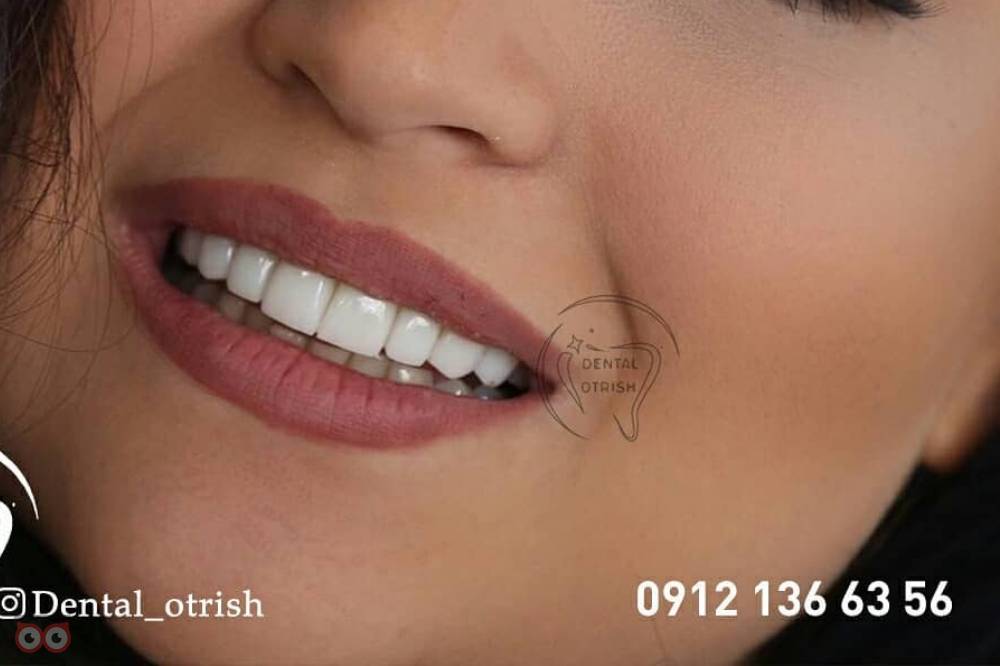 تخفیف ویژه کامپوزیت تخفیف ویژه کامپوزیت