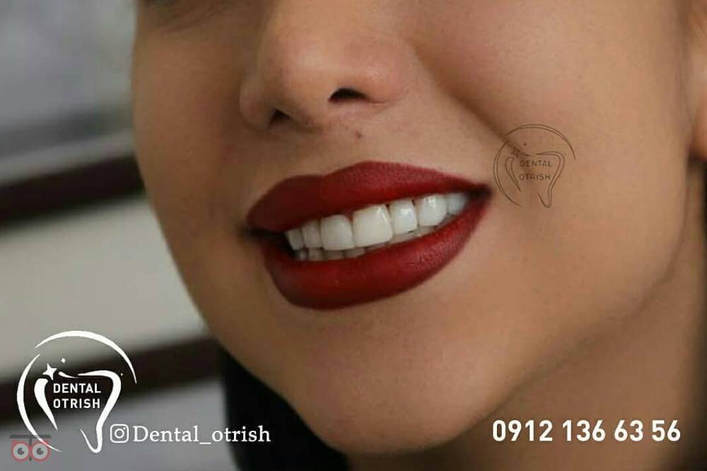 تخفیف ویژه کامپوزیت تخفیف ویژه کامپوزیت