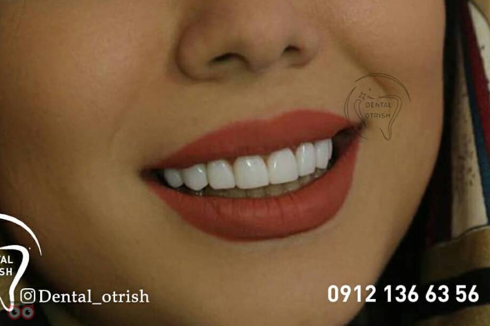 تخفیف ویژه کامپوزیت تخفیف ویژه کامپوزیت