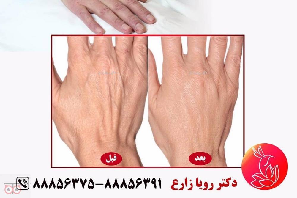 تخفیفات ویژه ماه مبارک رمضان در کلینیک زیبایی لوتوس زیر نظر دکتر رویا زارع تخفیفات ویژه ماه مبارک رمضان در کلینیک زیبایی لوتوس زیر نظر دکتر رویا زارع