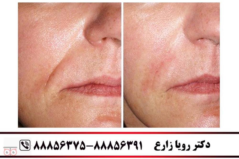 تخفیفات ویژه ماه مبارک رمضان در کلینیک زیبایی لوتوس زیر نظر دکتر رویا زارع تخفیفات ویژه ماه مبارک رمضان در کلینیک زیبایی لوتوس زیر نظر دکتر رویا زارع