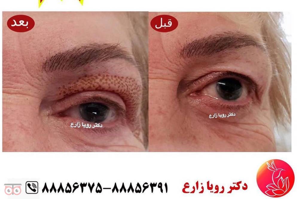 تخفیفات ویژه ماه مبارک رمضان در کلینیک زیبایی لوتوس زیر نظر دکتر رویا زارع تخفیفات ویژه ماه مبارک رمضان در کلینیک زیبایی لوتوس زیر نظر دکتر رویا زارع