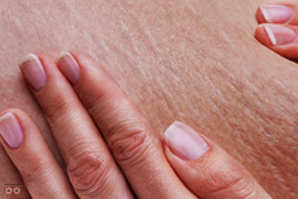 رفع سلولیت و ناهمواری های بدن رفع سلولیت و ناهمواری های بدن