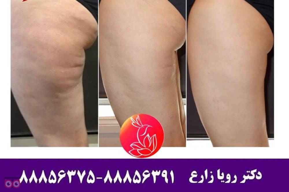 رفع سلولیت و ناهمواری های بدن رفع سلولیت و ناهمواری های بدن