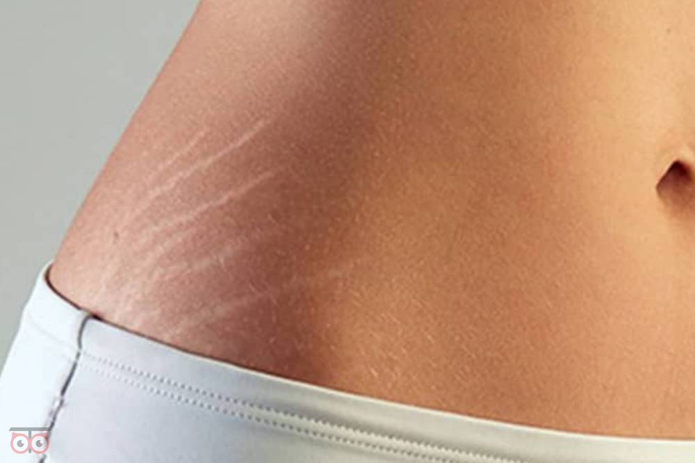 رفع ترک های پوستی با تخفیف ویژه رفع ترک های پوستی با تخفیف ویژه