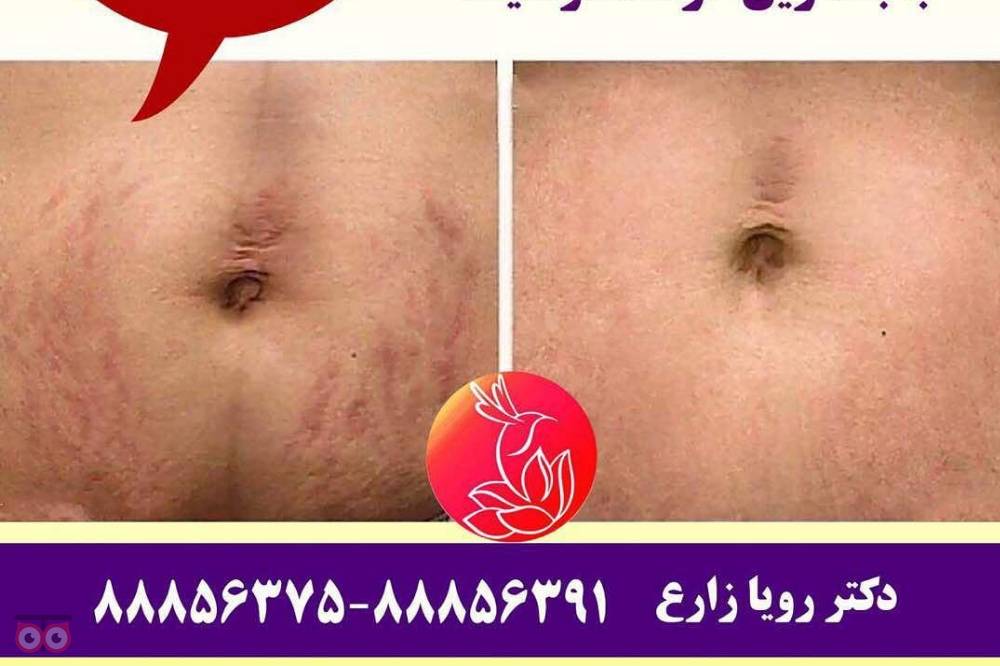 رفع ترک های پوستی با تخفیف ویژه رفع ترک های پوستی با تخفیف ویژه