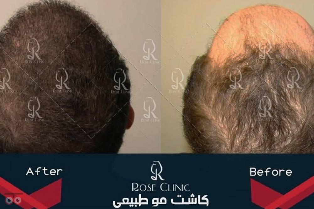 تمدید جشنواره کاشت تمدید جشنواره کاشت