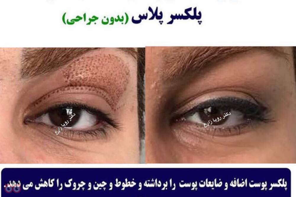 تخفیف ویژه پلکسر تخفیف ویژه پلکسر