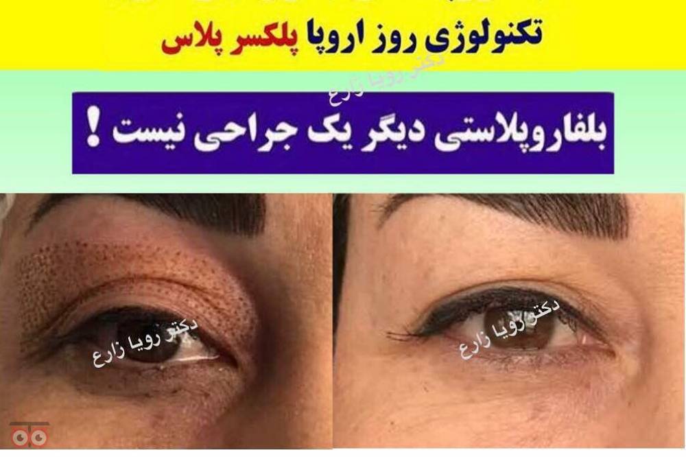 تخفیف ویژه پلکسر تخفیف ویژه پلکسر