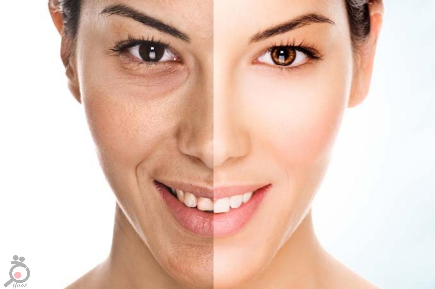 تخفیف ویژه لیزر ND تخفیف ویژه لیزر ND