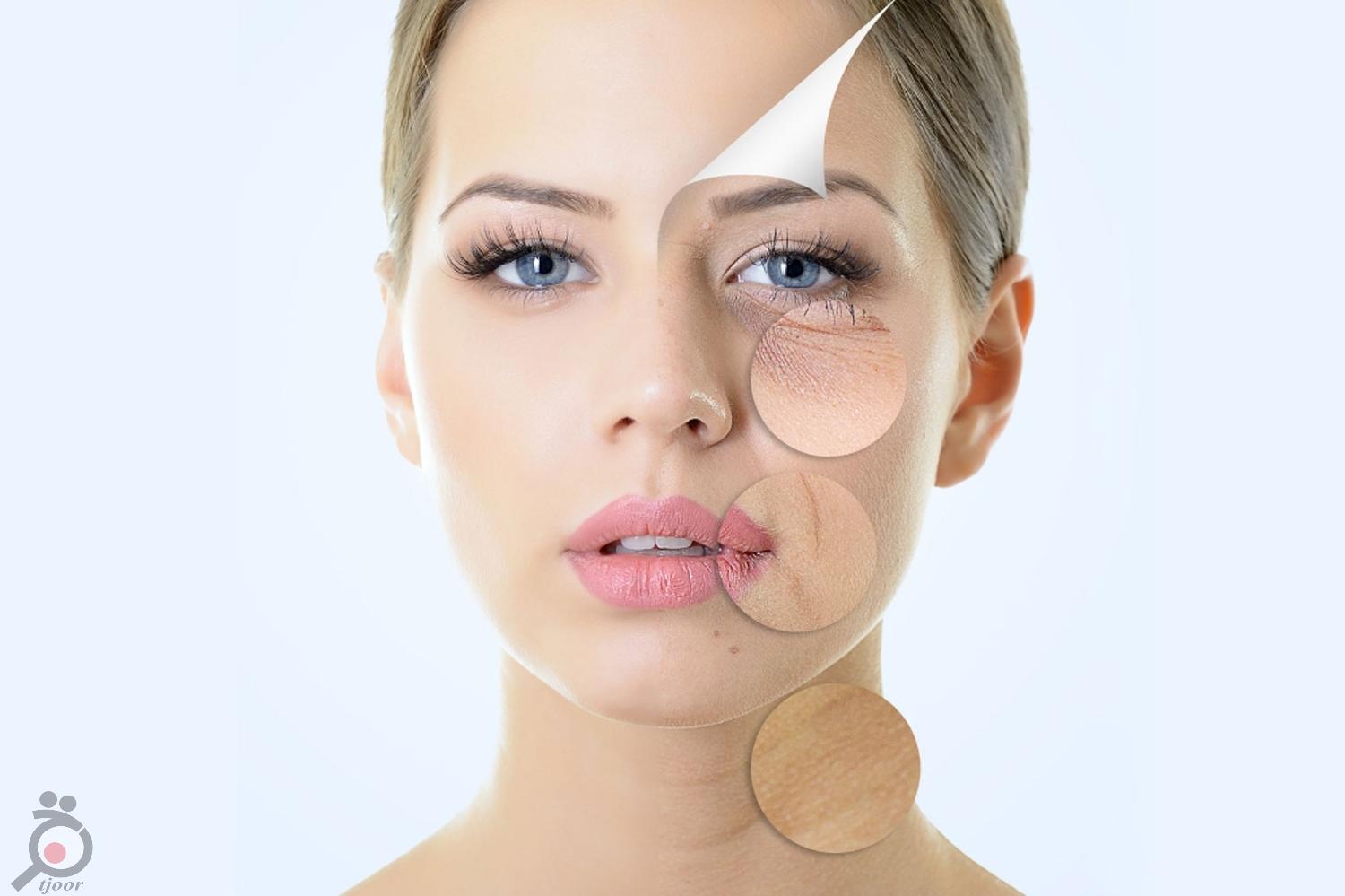 تخفیف ویژه لیزر ND تخفیف ویژه لیزر ND