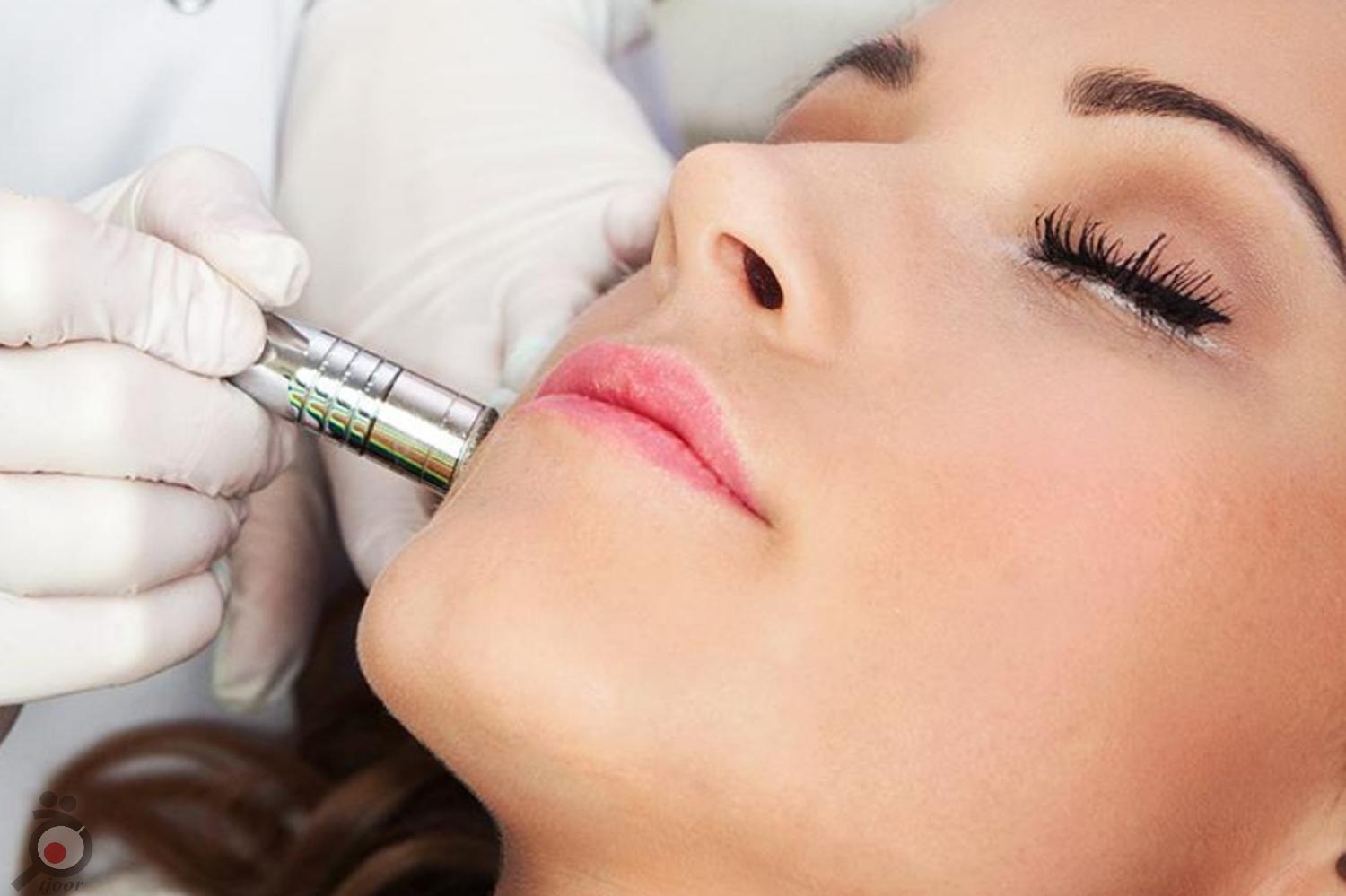 تخفیف ویژه میکرودرم ابریژن تخفیف ویژه میکرودرم ابریژن