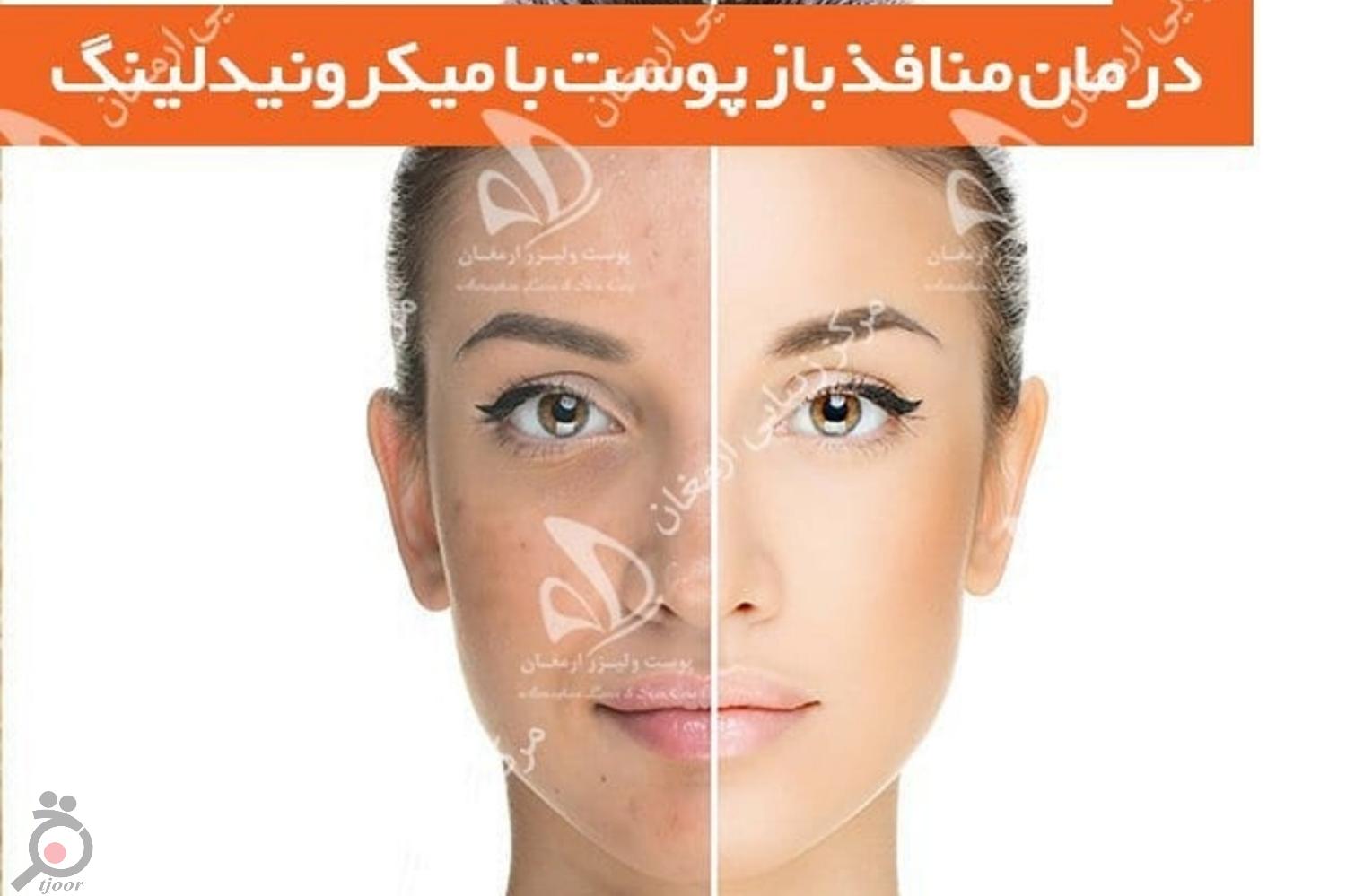 تخفیف ویژه لیزر تخفیف ویژه لیزر