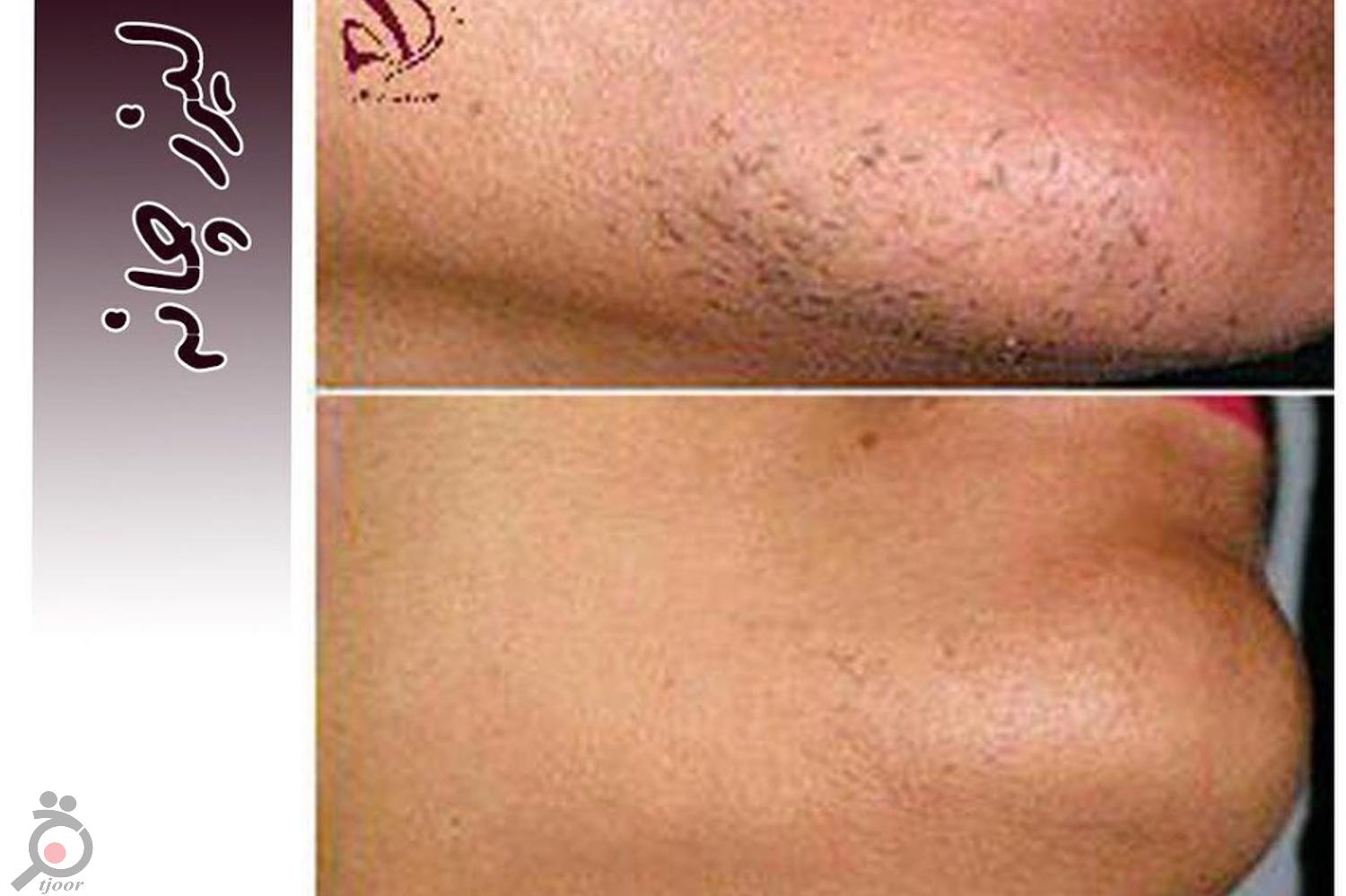 تخفیف ویژه لیزر تخفیف ویژه لیزر