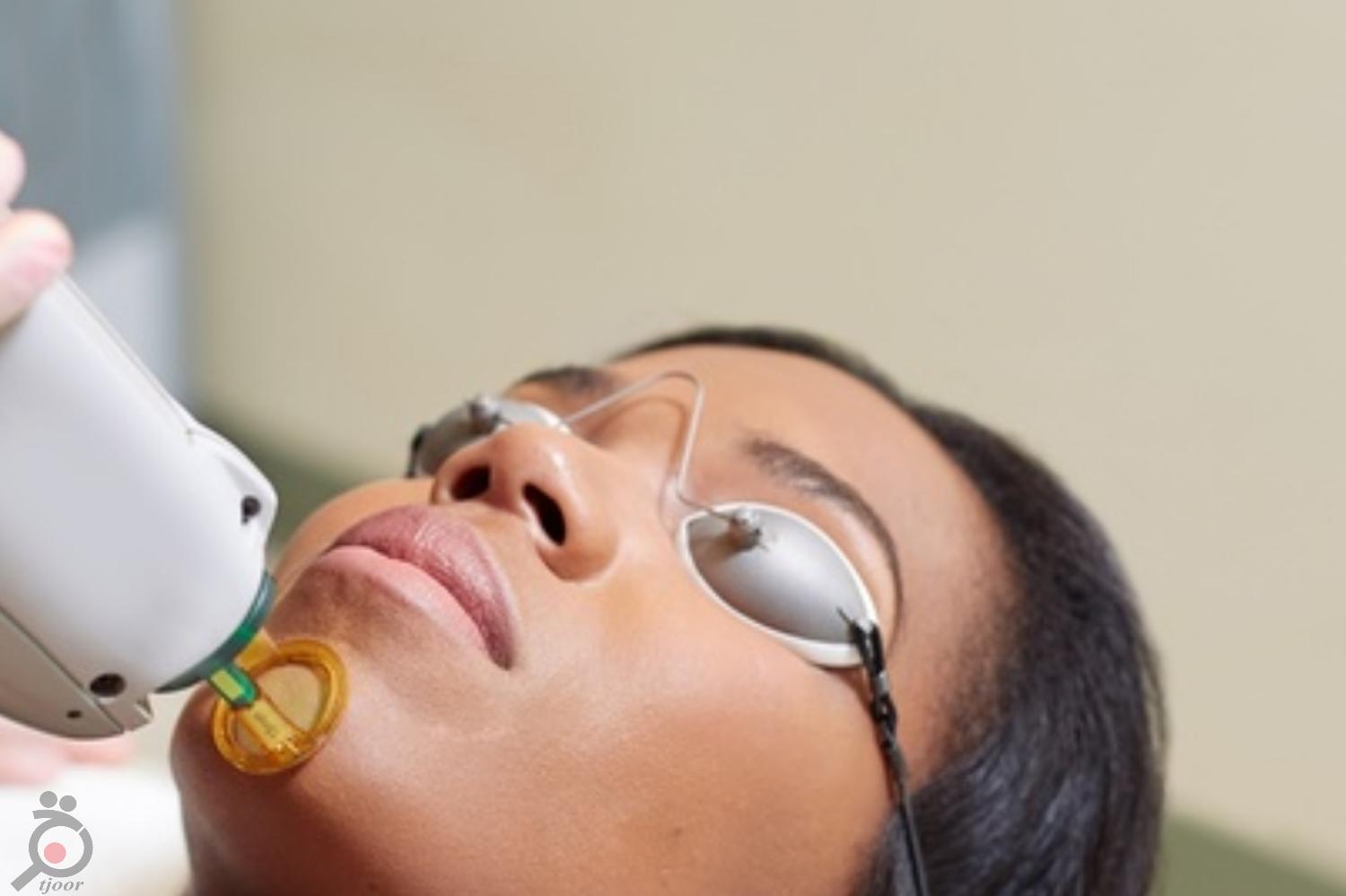 تخفیف زمستانی لیزر تخفیف زمستانی لیزر