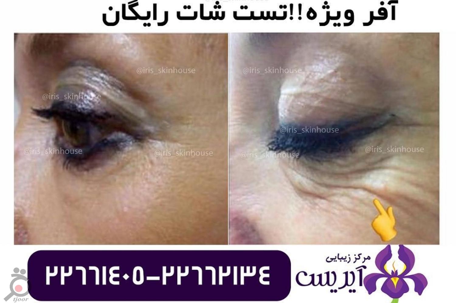 تخفیف ویژه خدمات رفع چروک و جوانسازی تخفیف ویژه خدمات رفع چروک و جوانسازی