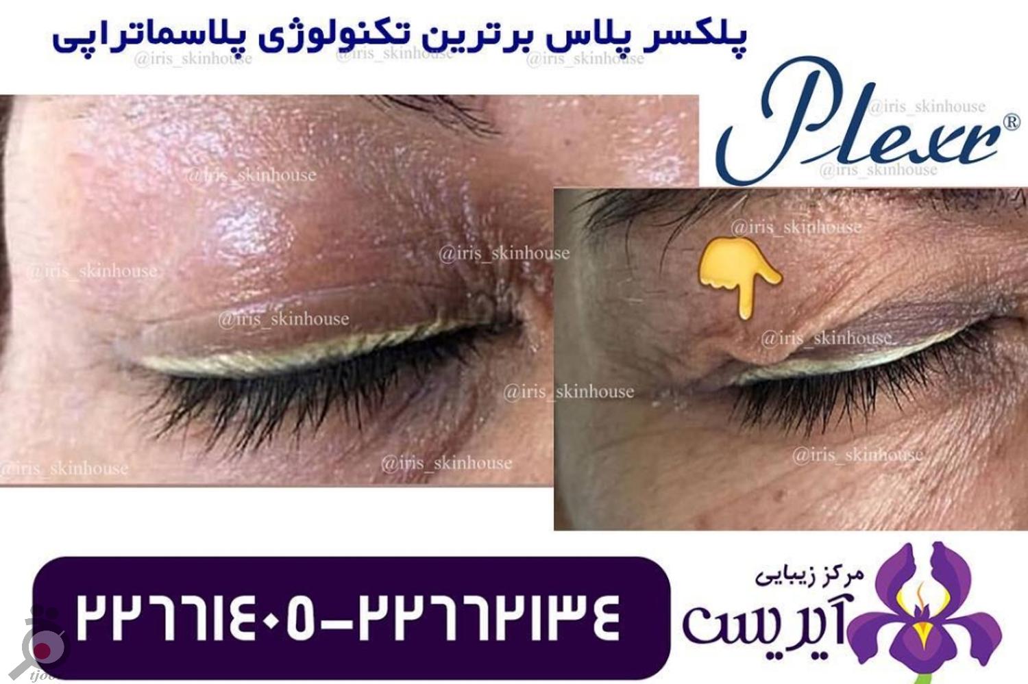 تخفیف ویژه خدمات رفع چروک و جوانسازی تخفیف ویژه خدمات رفع چروک و جوانسازی