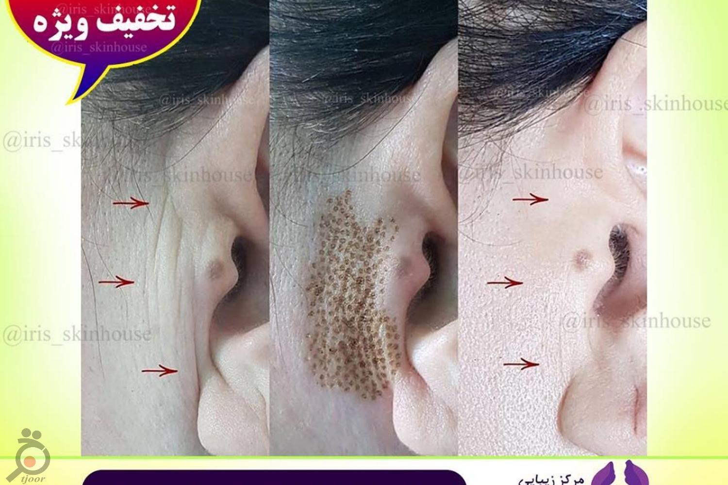 تخفیف ویژه خدمات رفع چروک و جوانسازی تخفیف ویژه خدمات رفع چروک و جوانسازی