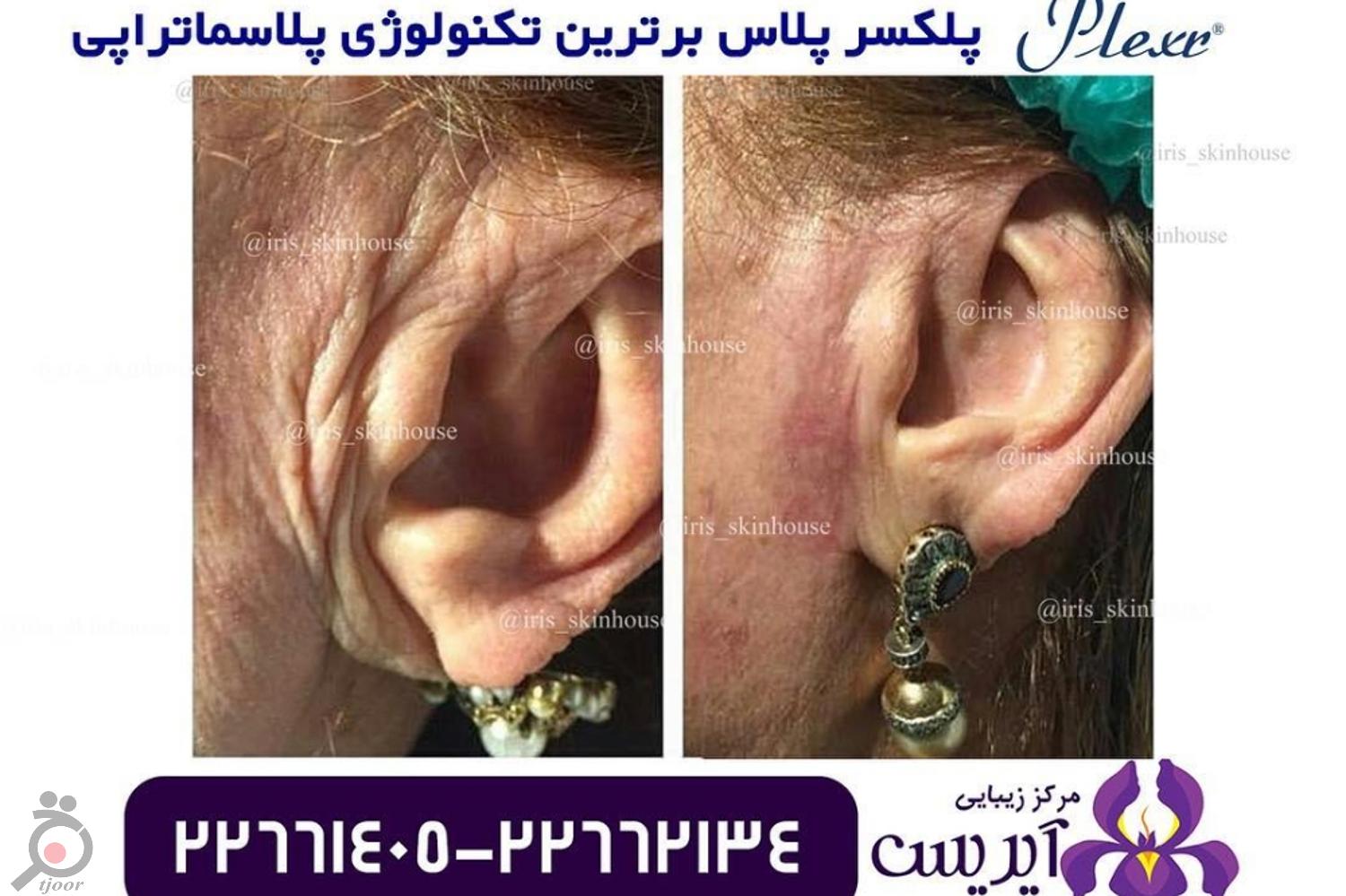 تخفیف ویژه خدمات رفع چروک و جوانسازی تخفیف ویژه خدمات رفع چروک و جوانسازی