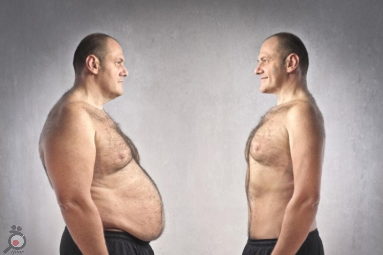 تخفیف ویژه زمستانی جراحی ماستوپکسی تخفیف ویژه زمستانی جراحی ماستوپکسی