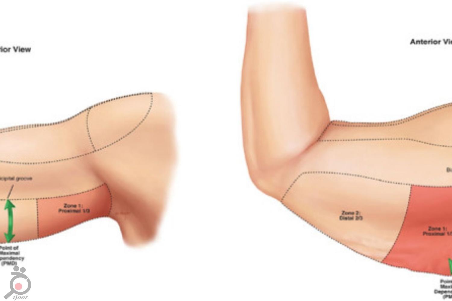 تخفیف ویژه زمستانی جراحی ماستوپکسی تخفیف ویژه زمستانی جراحی ماستوپکسی