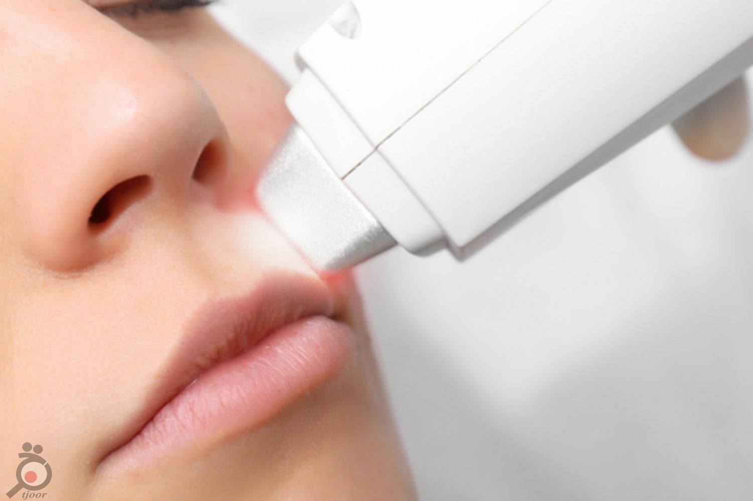 تخفیف ویژه پکیج لیزر تخفیف ویژه پکیج لیزر